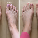 Esavie Hallux Valgus Corrector